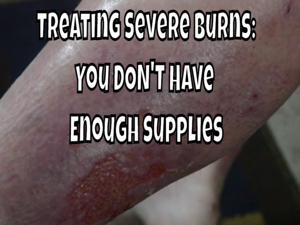 Treating Severe Burns: You DON'T Have Enough Supplies | Tennessee Gun